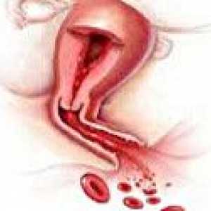 Hemoragie uterină