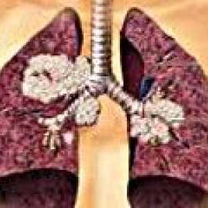 Cancer pulmonar cu celule mici
