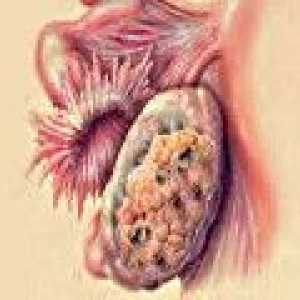 Cancer ovarian metastatic