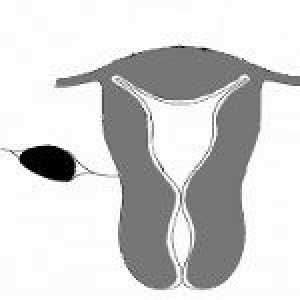 Fibrom uterin Mezhsvyazochnaya