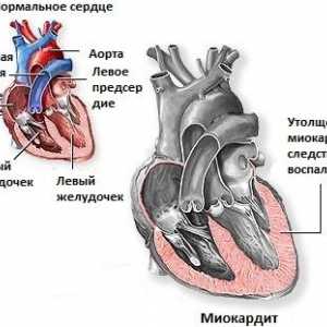 Miocardita