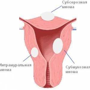 Histeromyomele