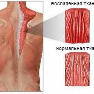 Mușchii miozită ale spatelui și a gâtului