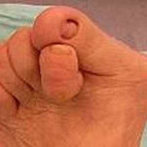 Degetele de la picioare Hammer