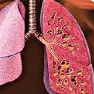 Pulmonare fibroza chistica
