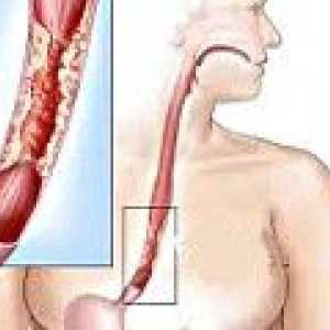 Obstructia esofagiana