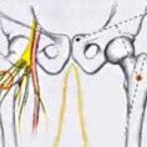 Neuropatia nervului femural
