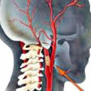 Ocluzia arterelor carotide