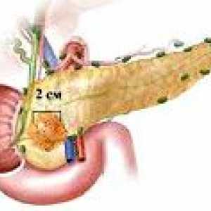 Tumorile pancreasului
