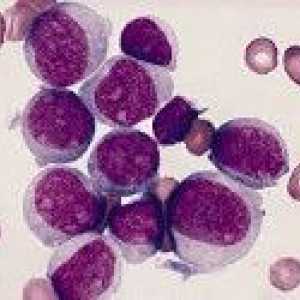 Leucemia mieloida acuta