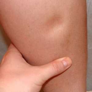 Umflarea picioarelor in timpul sarcinii
