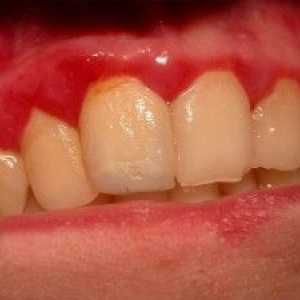 Boala parodontală: Simptome, cauze si tratament