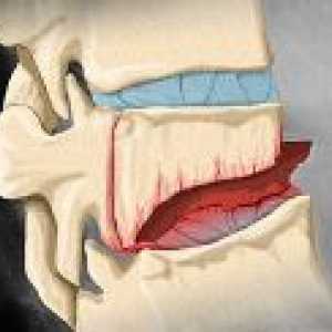 Fractura a coloanei vertebrale lombare