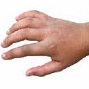 Fracturi ale oaselor mâinii și degetele la copii