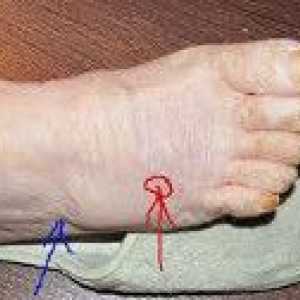 Fracturile oasele piciorului
