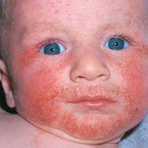 Alergii alimentare la copii