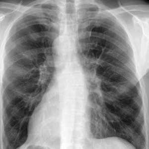 Simptome pneumonie, semne, tratamentul pneumoniei pulmonare