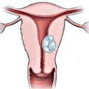 Fibrom uterin submucosal