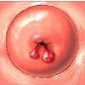 Polipii canalului cervical