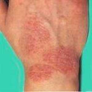 Eczema la locul de muncă