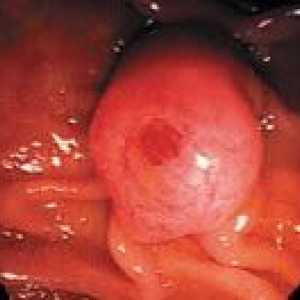 Cancerul de papilă duodenală majore