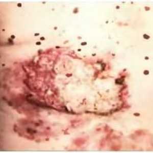 Cancer de piele, melanomul