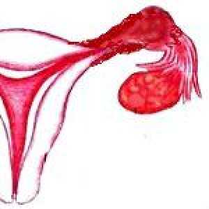Cancerul de trompa uterina