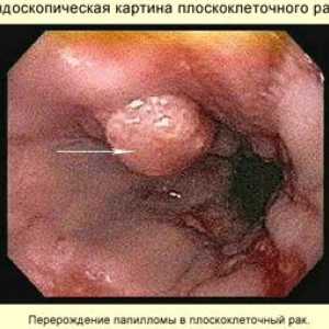 Tumorile maligne ale sistemului digestiv