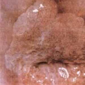 Cancerul de col uterin