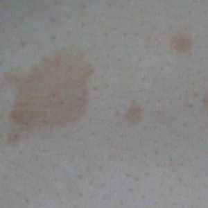 Pitiriazis versicolor (pitiriazis versicolor) pe piele