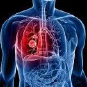 Recidiva de cancer pulmonar