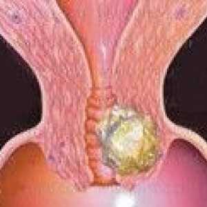 Reapariția cancerului de col uterin