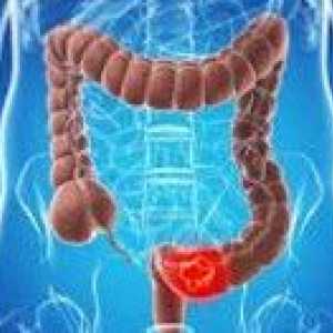 Recurenței cancerului de colon
