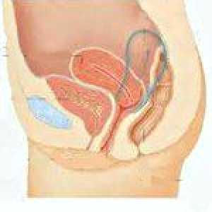 Retroflectat uterin