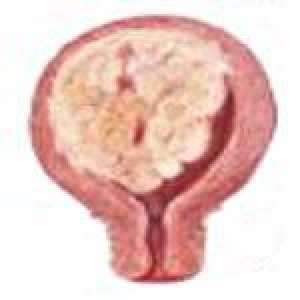 Sarcom uterin