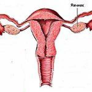 Sindromul ovarului rezistent