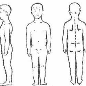 Scolioză a coloanei vertebrale, stoop, tulburare postura la copii și adulți