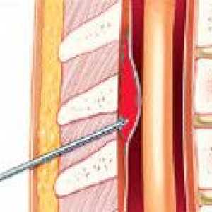 Hemoragiei epidurale spinale