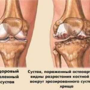 Gradul de osteoartritei