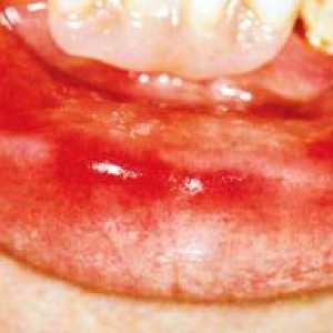 Stomatita: fotografie, simptome, tratament