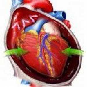 Tamponadă cardiacă