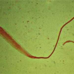 Trichuriasis (Whipworm)