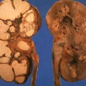 Tuberculoza a sistemului urogenital (nephrotuberculosis)