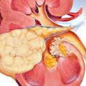 Carcinom cu celule renale Tubular