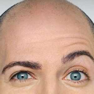 Tipuri de chelie (alopecie)