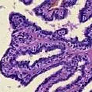 Papilom intraductal