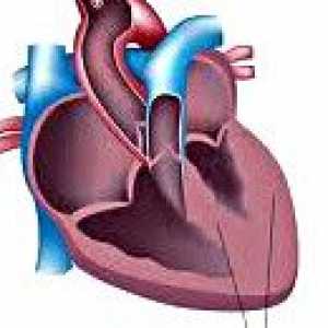 Cardiomiopatie secundară