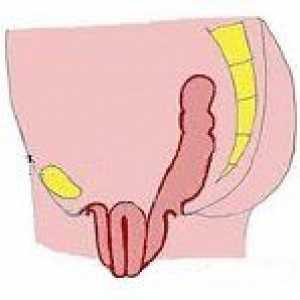 Prolapsul uterului si vaginului