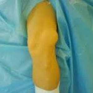 Dislocarea articulației genunchiului