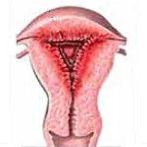 Hiperplazie endometrială glandulară